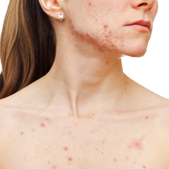 Acne Scar Treatment